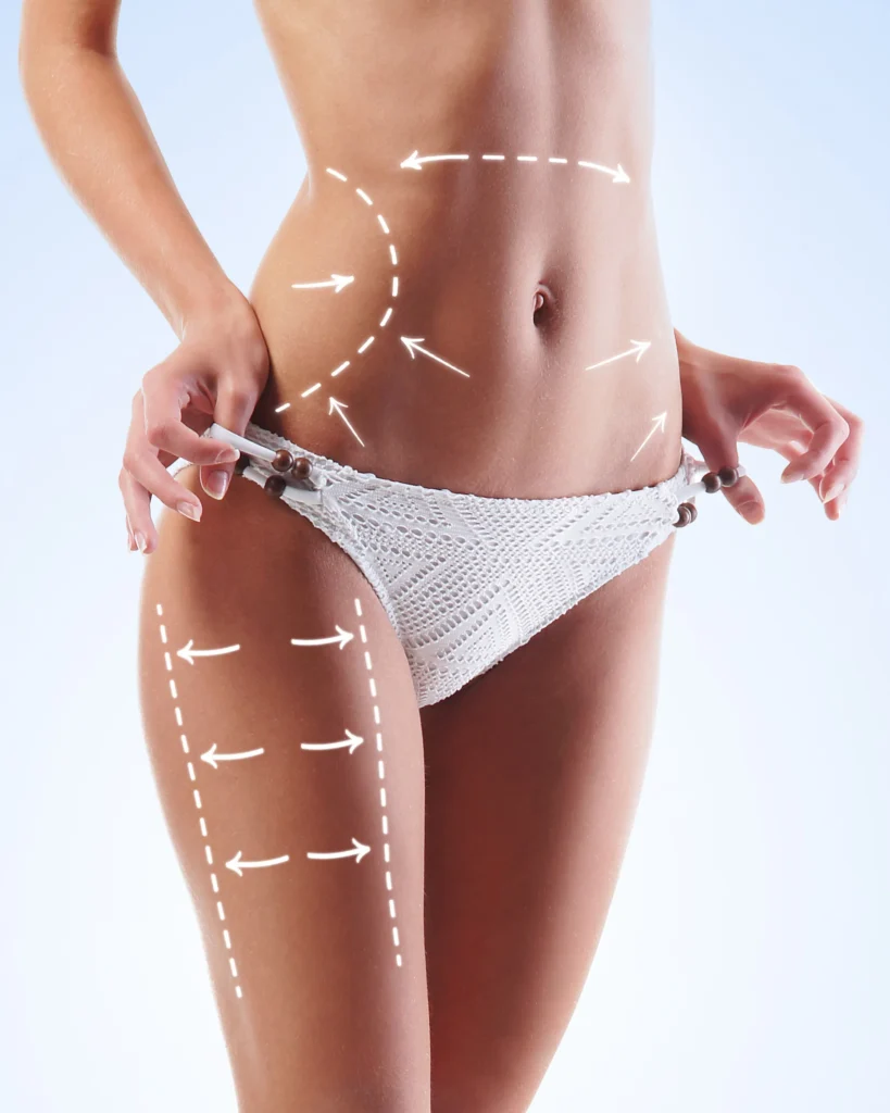 Remodelación corporal de abdomen y muslos
