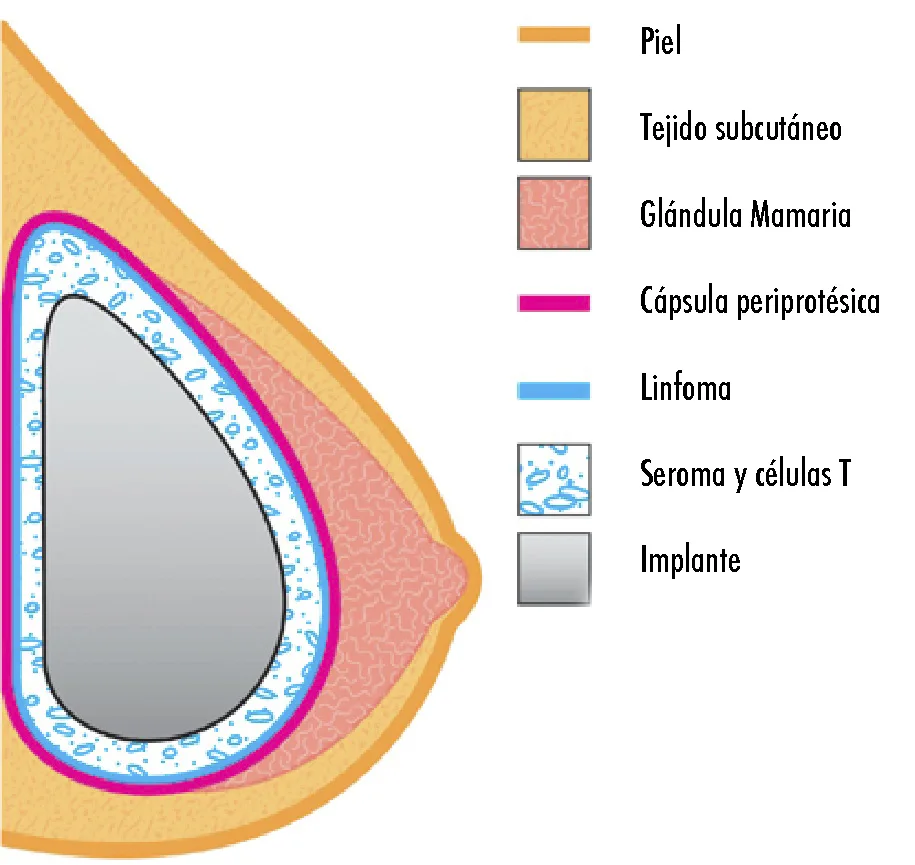 Implante mamario y cápsula periprotésica