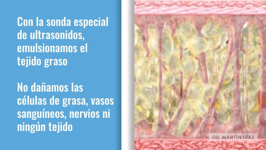Ultrasonidos para emulsión de tejido graso en liposucción Vaser
