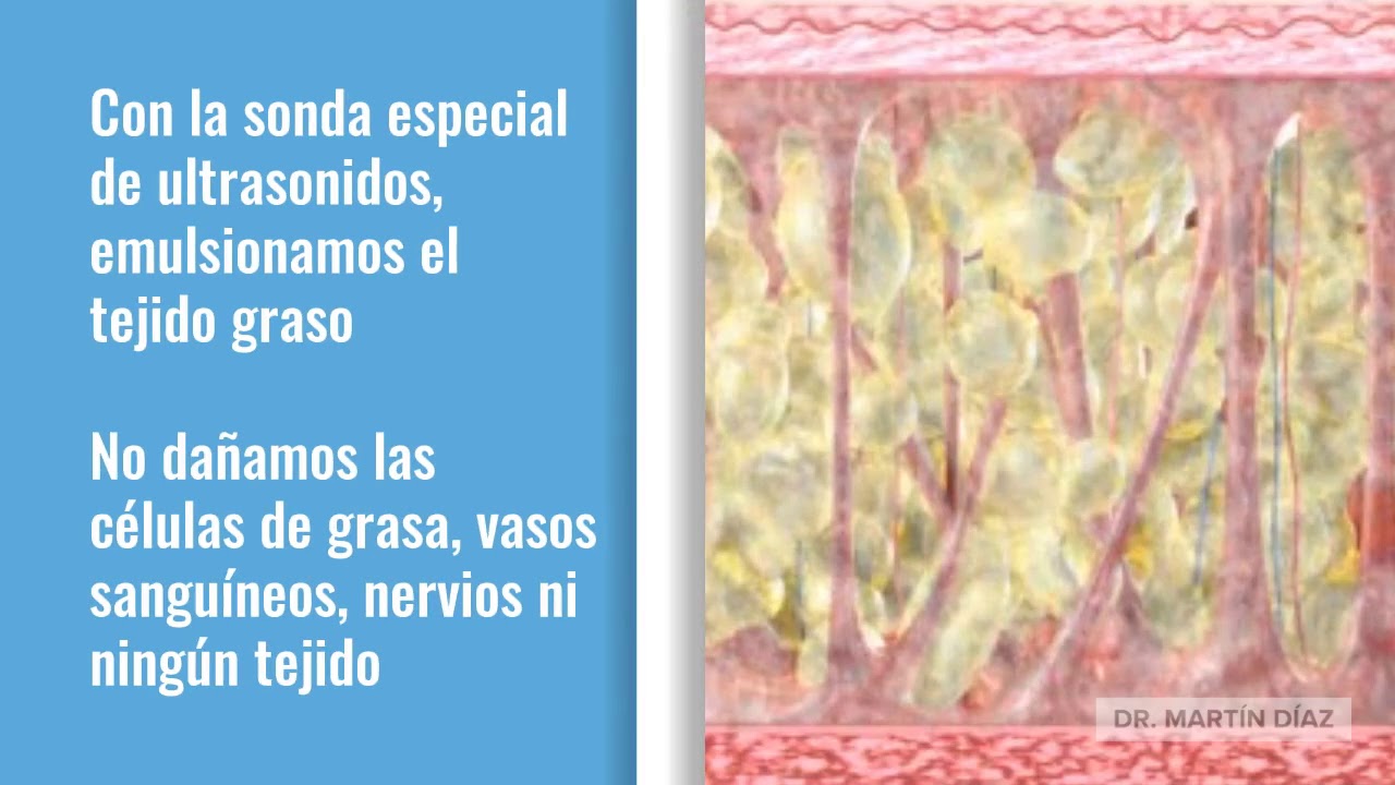 Ultrasonidos para emulsión de tejido graso en liposucción Vaser
