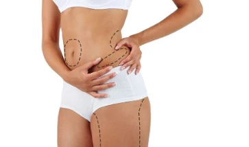 lipoescultura como se realiza
