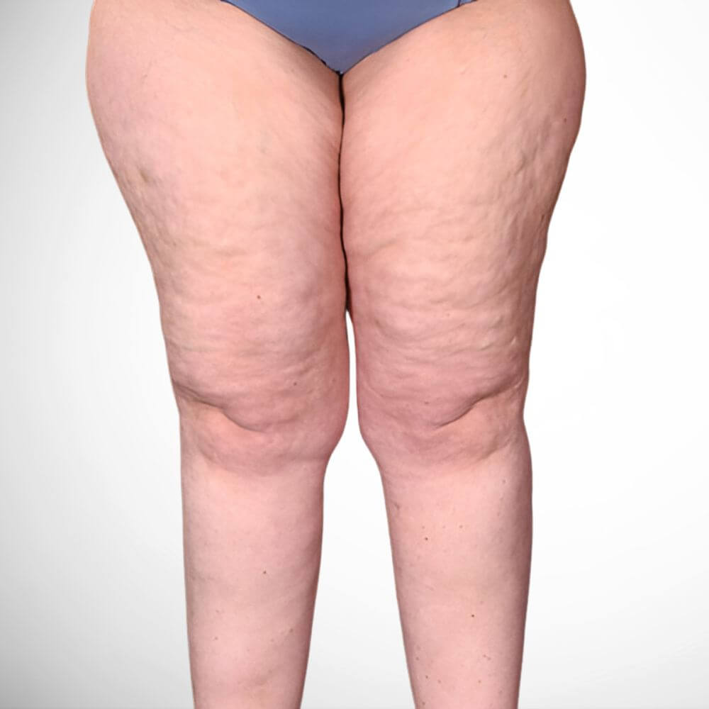Lipedema