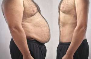abdominoplastia-hombres