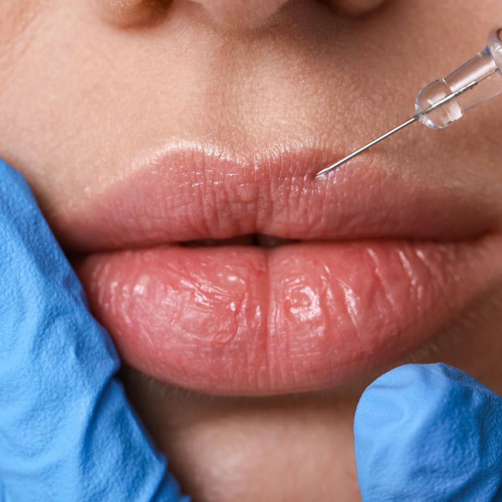Cómo bajar la hinchazón de los labios por ácido hialurónico