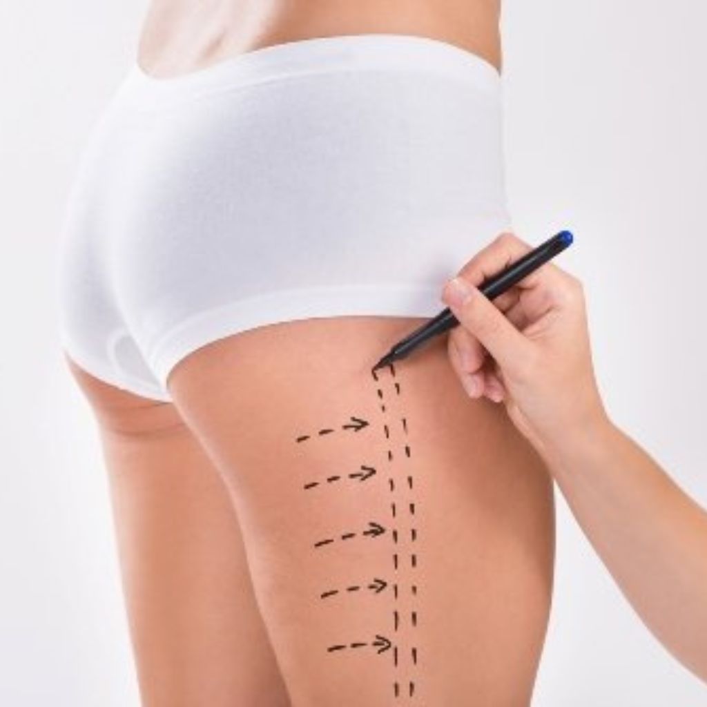 que es lipotransferencia