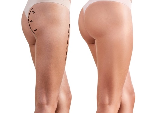 Aumento de gluteos con grasa -
