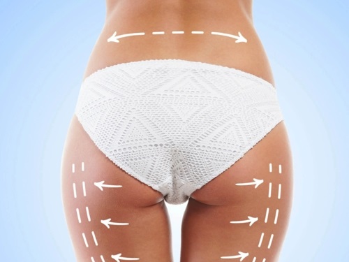 Lipofilling corporal -