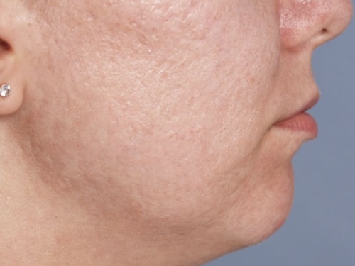 Mentoplastia